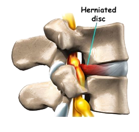 Chiropractic Surprise AZ Herniated Disc