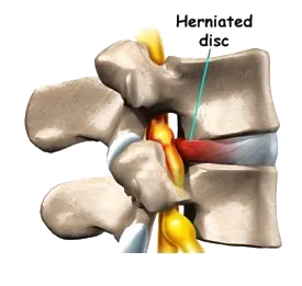 A 3D illustration of a herniated disc